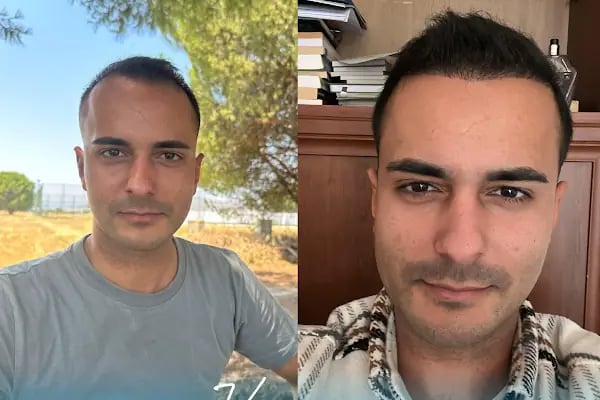 Vialux Hair Transplant | Ankara Saç Ekimi - Resim 8