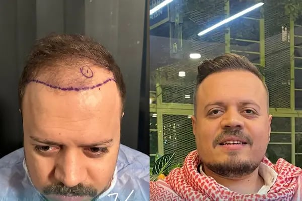 Vialux Hair Transplant | Ankara Saç Ekimi - Resim 12