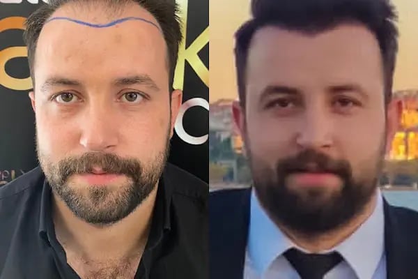 Gaziantep Saç Ekim Merkezi - Resim 16