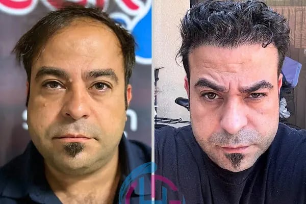 Gaziantep Saç Ekim Merkezi - Resim 19