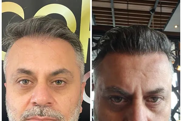 Gaziantep Saç Ekim Merkezi - Resim 20