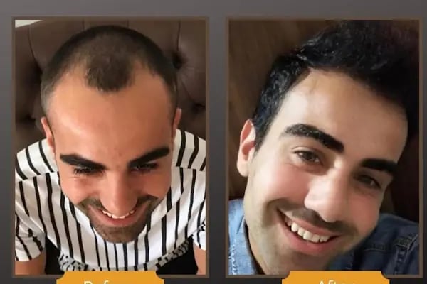 Ankara Saç Ekimi (Naturelhair) - Resim 4