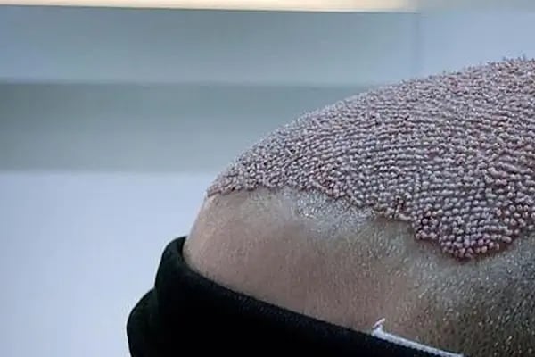 Ankara Saç Ekimi (Naturelhair) - Resim 1