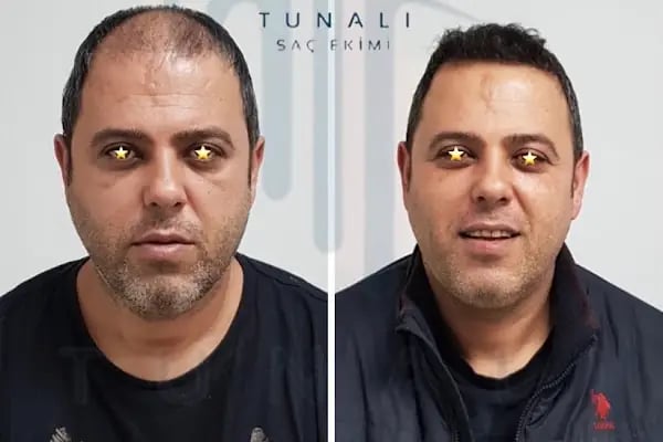 Tunalı Saç Ekimi I Ankara Saç ekimi - Resim 6