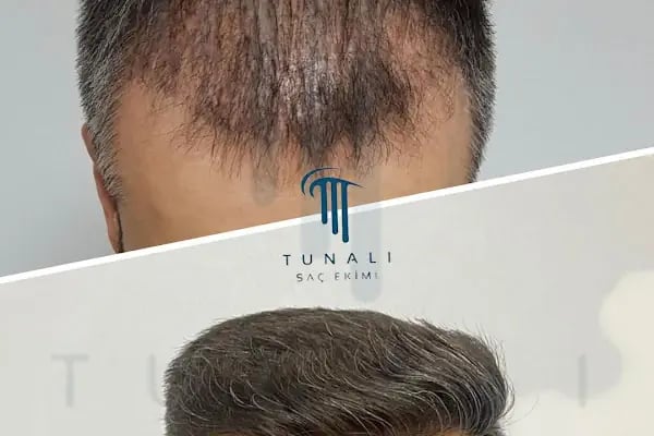 Tunalı Saç Ekimi I Ankara Saç ekimi - Resim 1