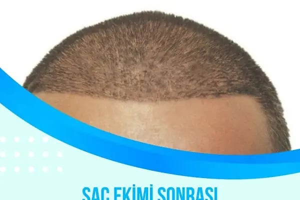 Tunalı Saç Ekimi I Ankara Saç ekimi - Resim 4
