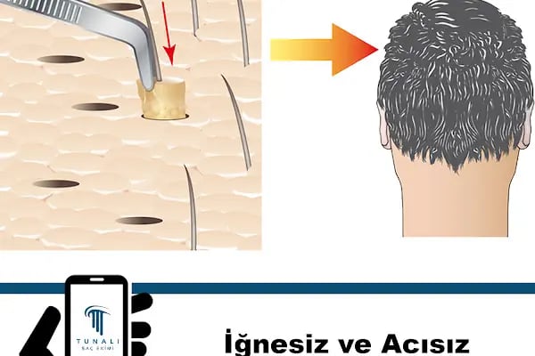 Tunalı Saç Ekimi I Ankara Saç ekimi - Resim 5