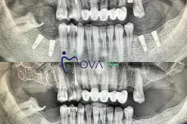 Alanya OvaDent Dental Clinic - Resim 5
