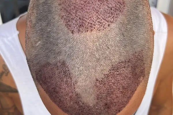 Aisha Hair | Injerto Capilar Turquía | Hair Transplant Turkey - Resim 6