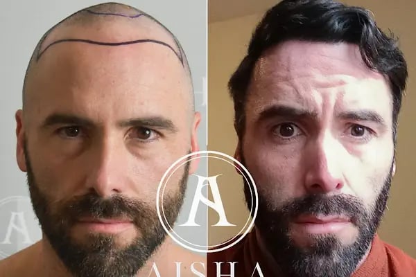 Aisha Hair | Injerto Capilar Turquía | Hair Transplant Turkey - Resim 15