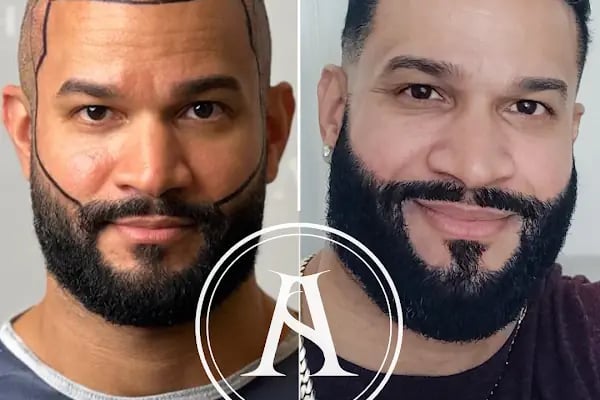 Aisha Hair | Injerto Capilar Turquía | Hair Transplant Turkey - Resim 19