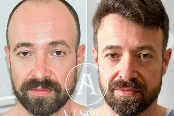 Aisha Hair | Injerto Capilar Turquía | Hair Transplant Turkey - Resim 16