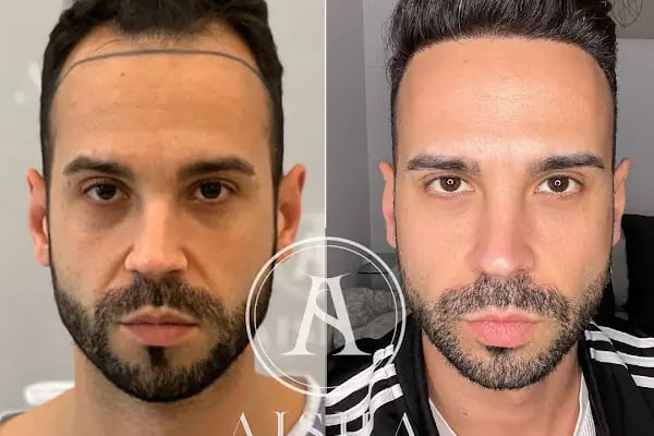 Aisha Hair | Injerto Capilar Turquía | Hair Transplant Turkey - Resim 17