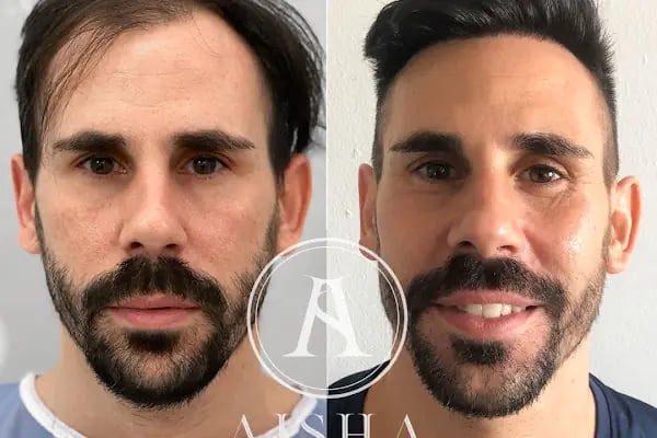 Aisha Hair | Injerto Capilar Turquía | Hair Transplant Turkey - Resim 18
