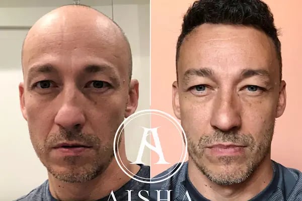 Aisha Hair | Injerto Capilar Turquía | Hair Transplant Turkey - Resim 11