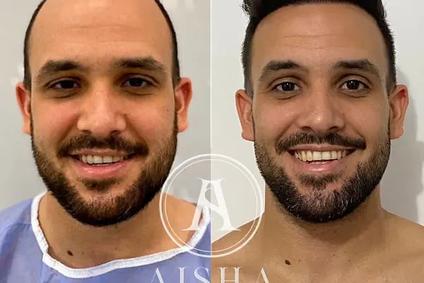 Aisha Hair | Injerto Capilar Turquía | Hair Transplant Turkey - Resim 13