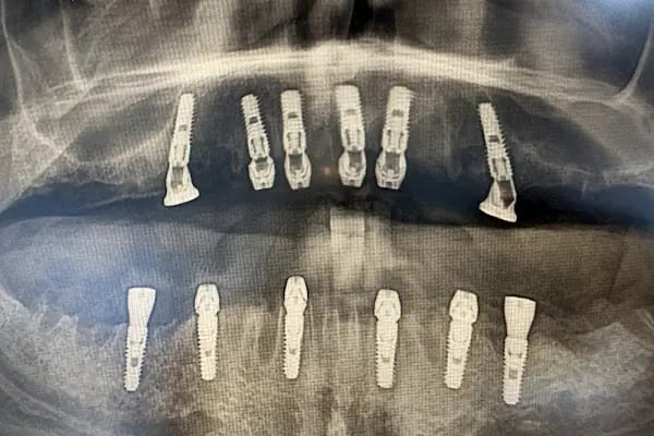 Dentbien Ağız ve Diş Sağlığı Polikliniği / Ataşehir İmplant Diş Kliniği - Resim 14