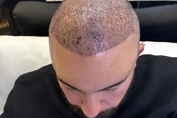 Medical of Istanbul Hospital Hair Transplant | Dental | Aesthetic Treatments - Resim 16