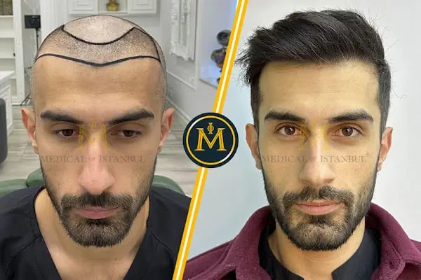Medical of Istanbul Hospital Hair Transplant | Dental | Aesthetic Treatments - Resim 18