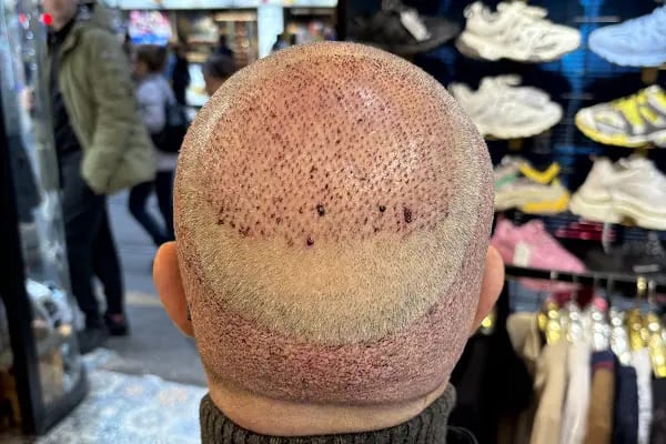 Medical of Istanbul Hospital Hair Transplant | Dental | Aesthetic Treatments - Resim 8
