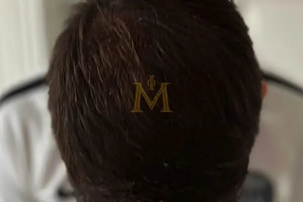 Medical of Istanbul Hospital Hair Transplant | Dental | Aesthetic Treatments - Resim 9