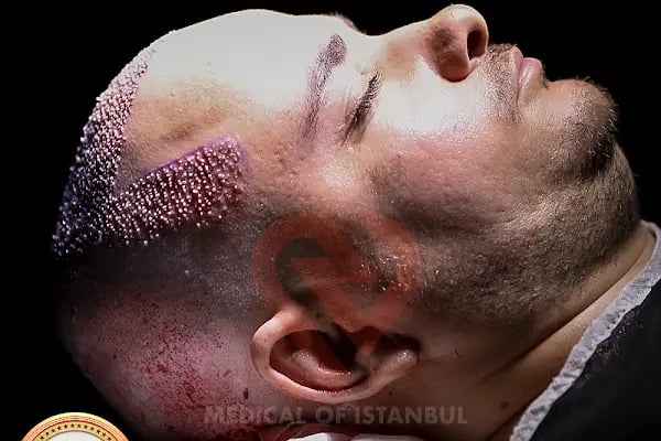 Medical of Istanbul Hospital Hair Transplant | Dental | Aesthetic Treatments - Resim 20