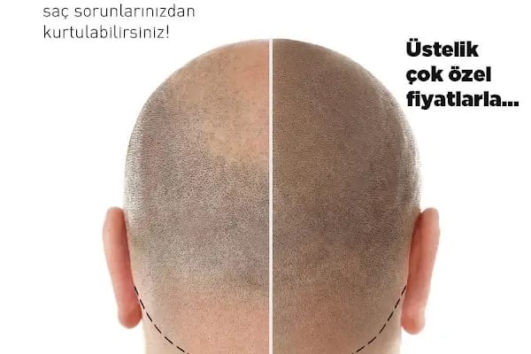 DENİZLİ SAÇ SİMÜLASYON - LÜTFİYE İNAMLIK - Resim 6