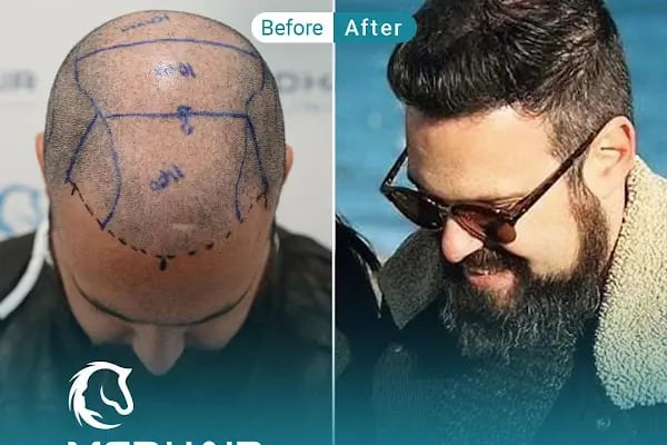 MedHair Clinic - Resim 5