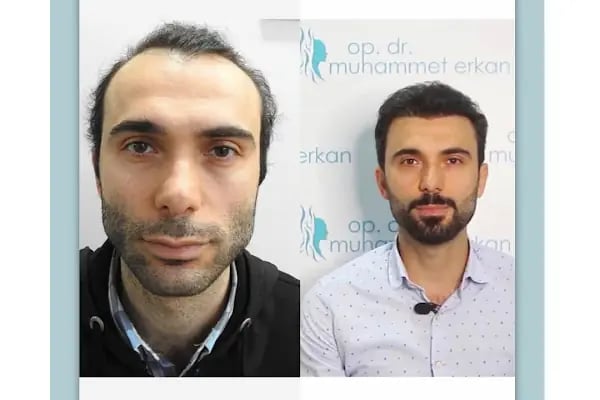 S&amp;U Protez Saçlandırma Merkezi - Resim 14