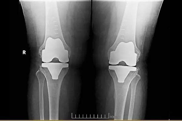 Op. Dr. Ömer Yonga- İstanbul Ortopedi ve Travmatoloji Doktoru - Resim 14
