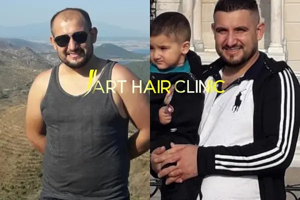 Art Hair Clinic Saç Ekim Merkezi İzmir - En iyi saç ekim merkezi İzmir - Resim 12