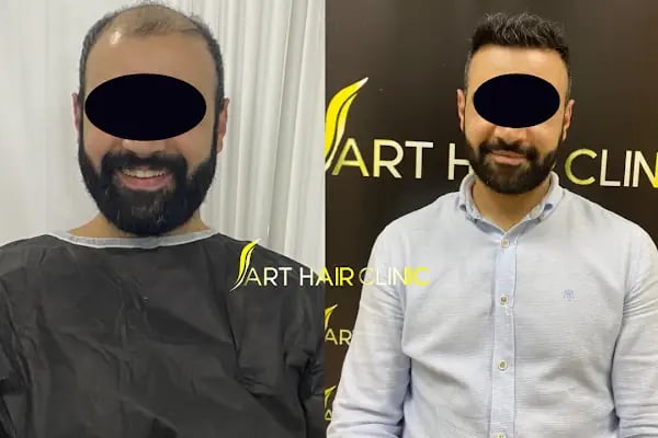 Art Hair Clinic Saç Ekim Merkezi İzmir - En iyi saç ekim merkezi İzmir - Resim 8
