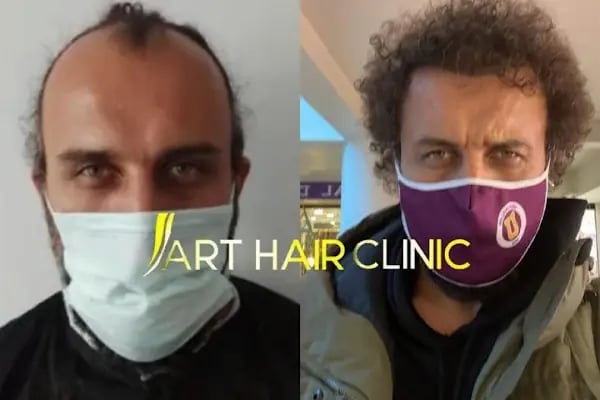 Art Hair Clinic Saç Ekim Merkezi İzmir - En iyi saç ekim merkezi İzmir - Resim 11