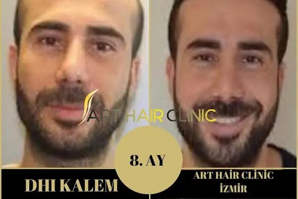 Art Hair Clinic Saç Ekim Merkezi İzmir - En iyi saç ekim merkezi İzmir - Resim 13