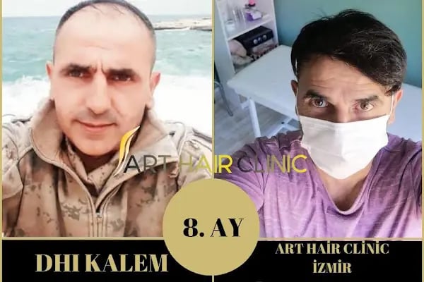 Art Hair Clinic Saç Ekim Merkezi İzmir - En iyi saç ekim merkezi İzmir - Resim 10