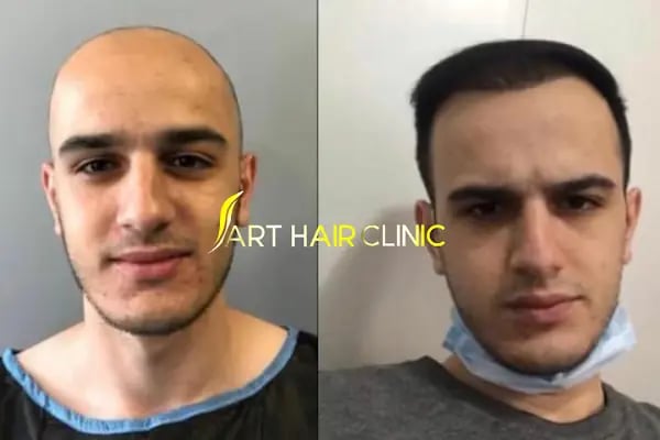 Art Hair Clinic Saç Ekim Merkezi İzmir - En iyi saç ekim merkezi İzmir - Resim 9