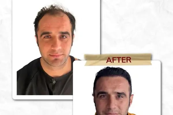 Art Hair Clinic Saç Ekim Merkezi İzmir - En iyi saç ekim merkezi İzmir - Resim 19