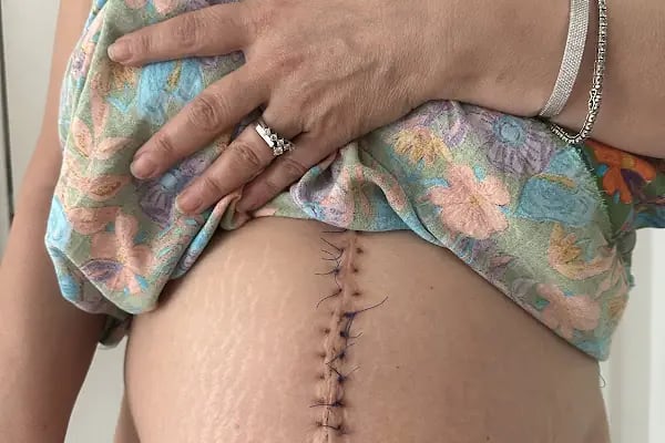 Op.Dr. Özden Avcı - Obezite Cerrahisi - Resim 12