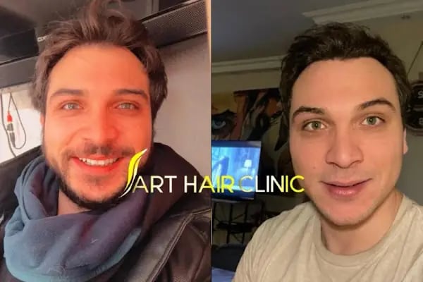 Art Hair Clinic Saç Ekim Merkezi İzmir - En iyi saç ekim merkezi İzmir - Resim 14