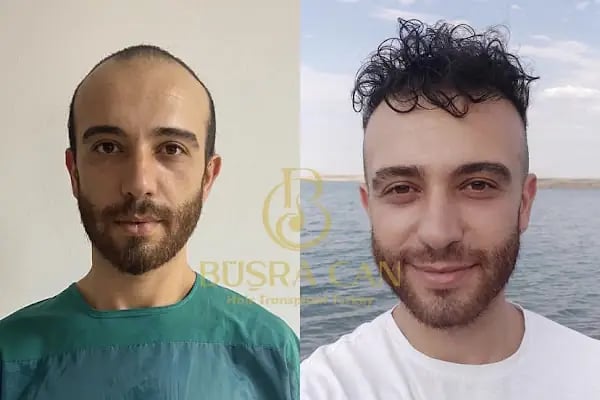 MUĞLA SAÇ EKİM MERKEZİ BÜŞRA CAN SAÇ EKİM MERKEZİ /BÜŞRA CAN HAİR TRANSPLANT - Resim 4