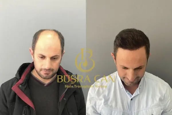 MUĞLA SAÇ EKİM MERKEZİ BÜŞRA CAN SAÇ EKİM MERKEZİ /BÜŞRA CAN HAİR TRANSPLANT - Resim 5