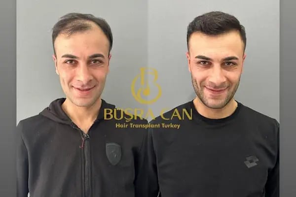 MUĞLA SAÇ EKİM MERKEZİ BÜŞRA CAN SAÇ EKİM MERKEZİ /BÜŞRA CAN HAİR TRANSPLANT - Resim 16
