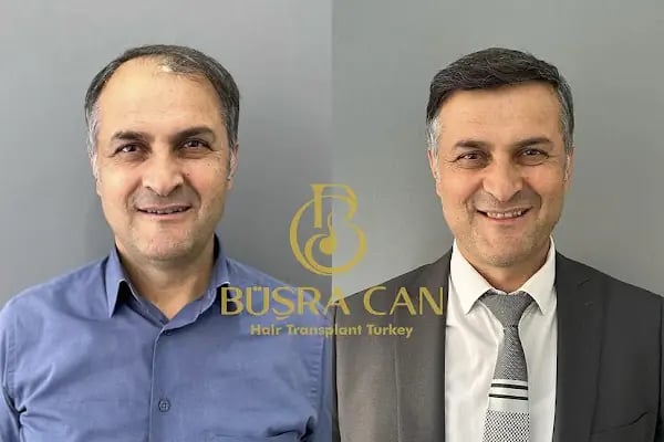 MUĞLA SAÇ EKİM MERKEZİ BÜŞRA CAN SAÇ EKİM MERKEZİ /BÜŞRA CAN HAİR TRANSPLANT - Resim 14