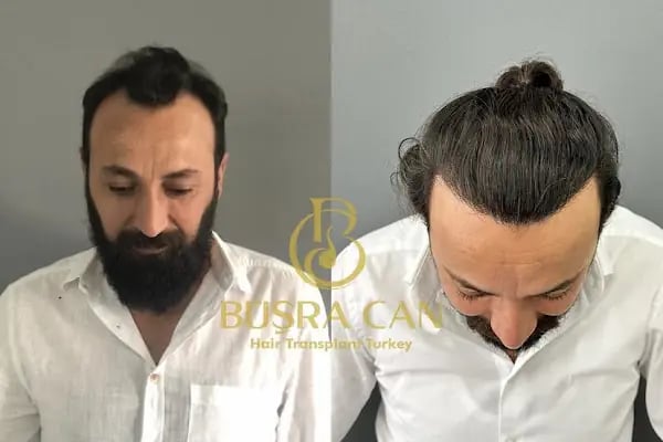 MUĞLA SAÇ EKİM MERKEZİ BÜŞRA CAN SAÇ EKİM MERKEZİ /BÜŞRA CAN HAİR TRANSPLANT - Resim 8