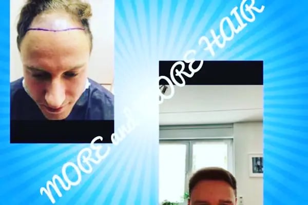 More and More Hair Transplantation And Beauty Clinic - Resim 20