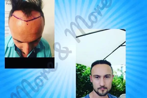 More and More Hair Transplantation And Beauty Clinic - Resim 19