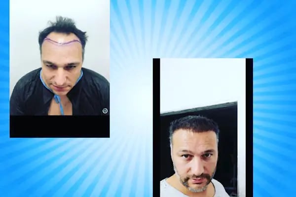 More and More Hair Transplantation And Beauty Clinic - Resim 15
