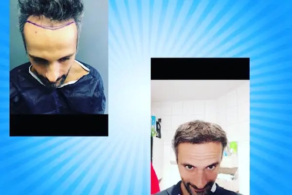 More and More Hair Transplantation And Beauty Clinic - Resim 18