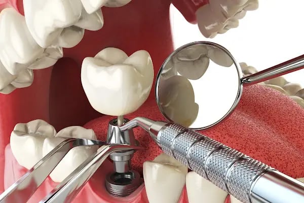 Uzm.Dr. Berk EROL | Çene Cerrahisi ve İmplant Kliniği - Resim 3