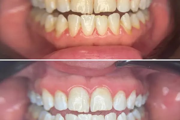 Diş Hekimi Tuğçe ÖZKAN - Elmalı Dent Diş Polikliniği - Resim 12